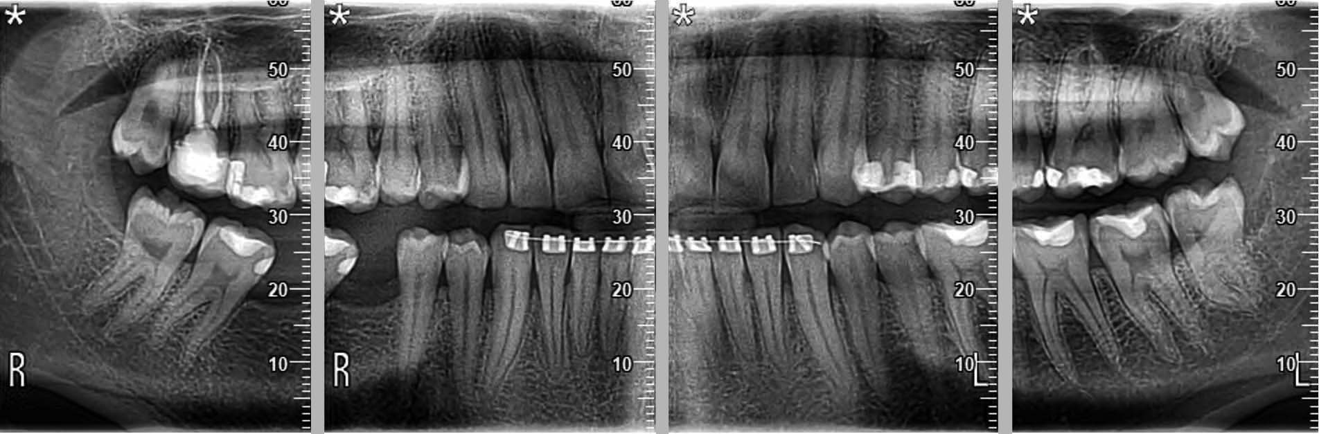 DENTİSYON VE BITEWING İNCELEMELERİ 